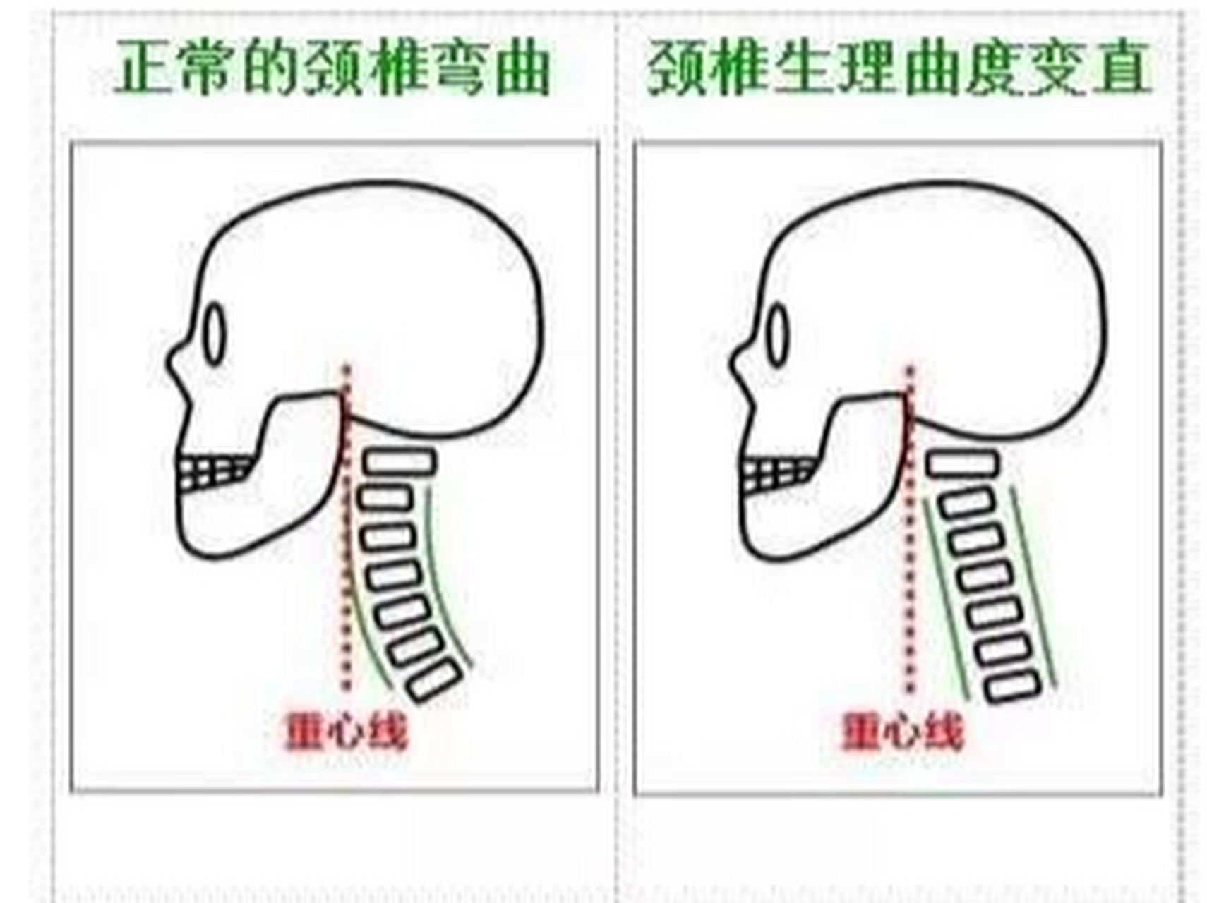 头颈过伸位图片