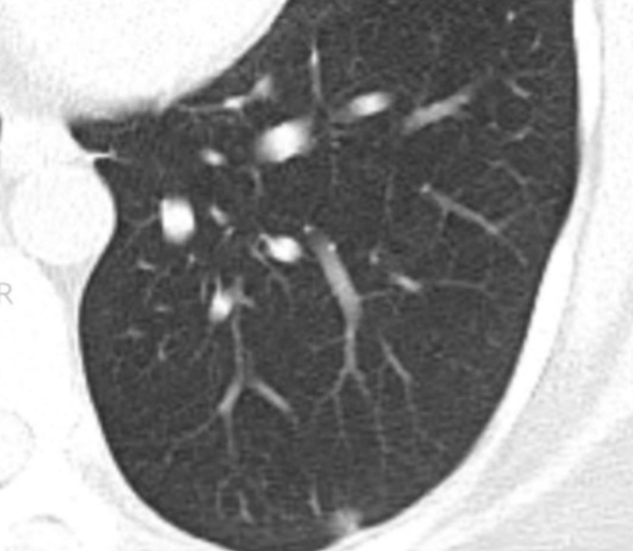 肺原位癌,微浸润癌,浸润癌,谁术后能达到"治愈"?