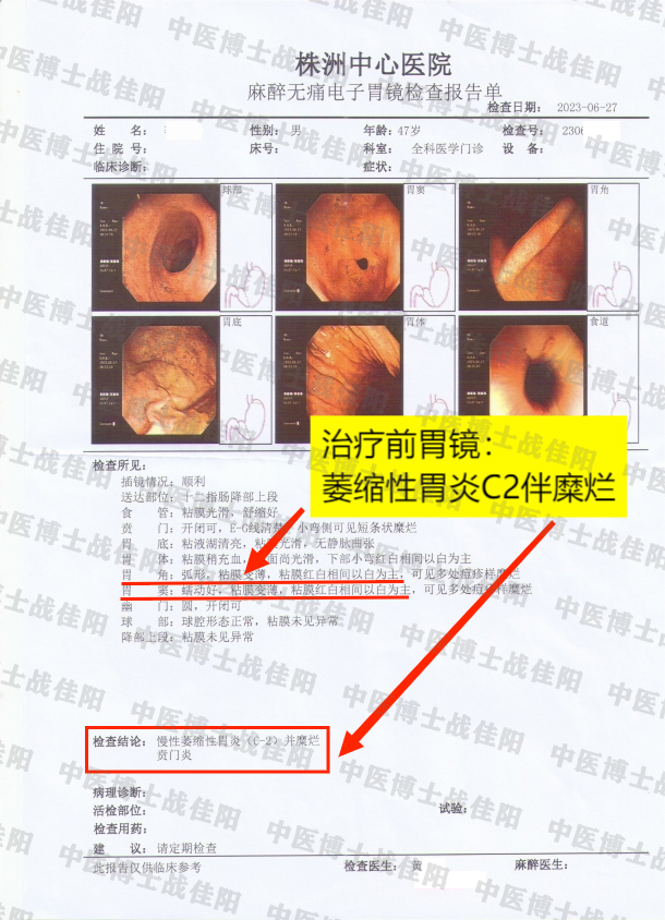 2022年3次做胃镜检查,都显示为萎缩性胃炎 2023年6越做胃镜,报告显示