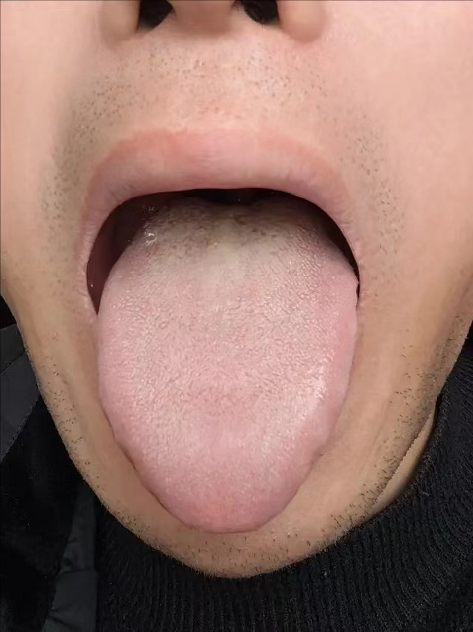 这样的舌苔,要脾肾同调,千万别乱吃补肾药!
