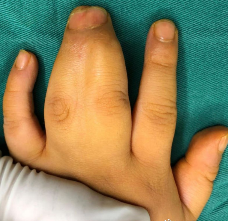 的治疗效果更为显著 先天性并指(趾)畸形是指两个或两个以上指