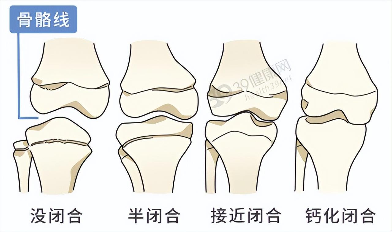 骨骺示意图图片