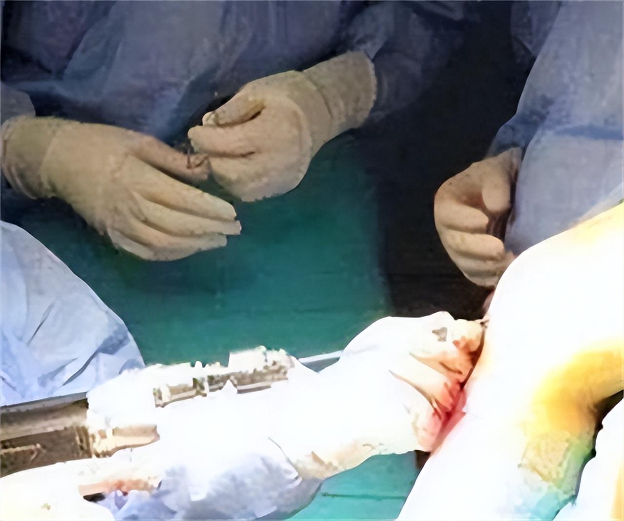 回顾14年20岁男孩李亚诺花16万断骨增高72厘米后来怎样