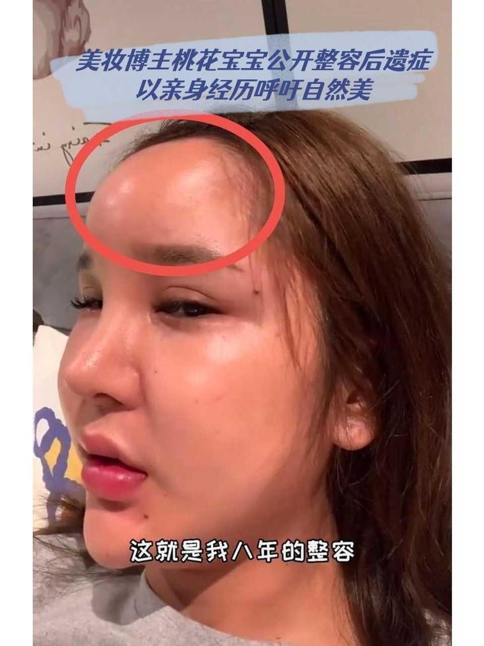 美妆博主桃花宝宝公开整容后遗症以亲身经历呼吁自然美