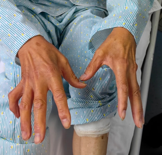 一旦糖尿病出现了周围神经病变,不及早发现和治疗,可能形成爪形手