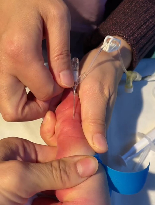 新生儿大隐静脉留置针穿刺分享