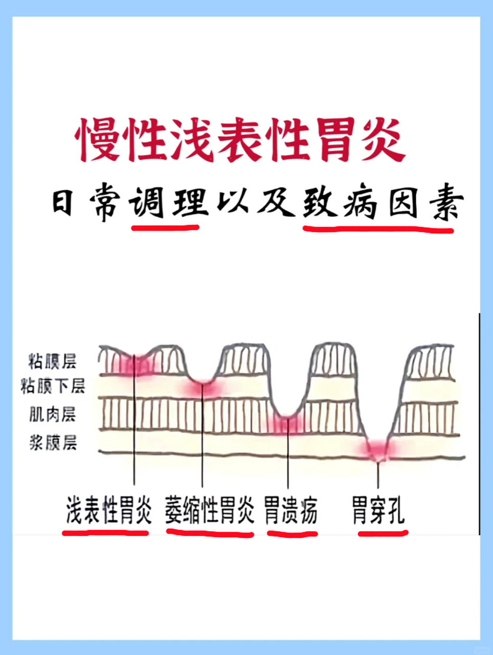 反复发作,日常维护不当,很可能出现胃穿孔~ 症状:上腹痛,嗳气,腹胀