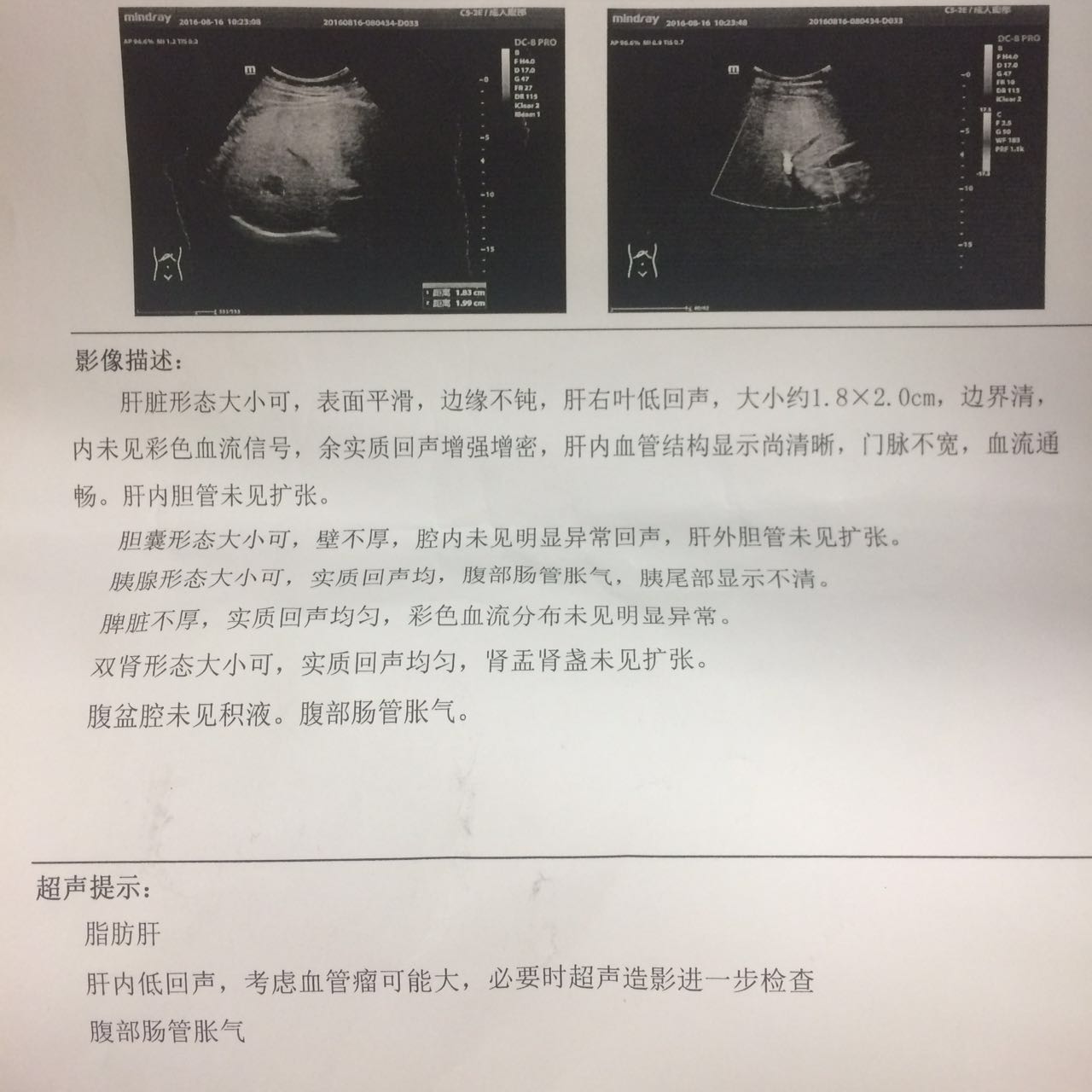 肝硬化彩超表现图片