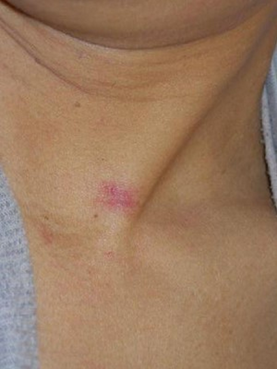 济南本地人,上午查房的时候发现他脖子上出现了比较明显的蜘蛛痣,也有