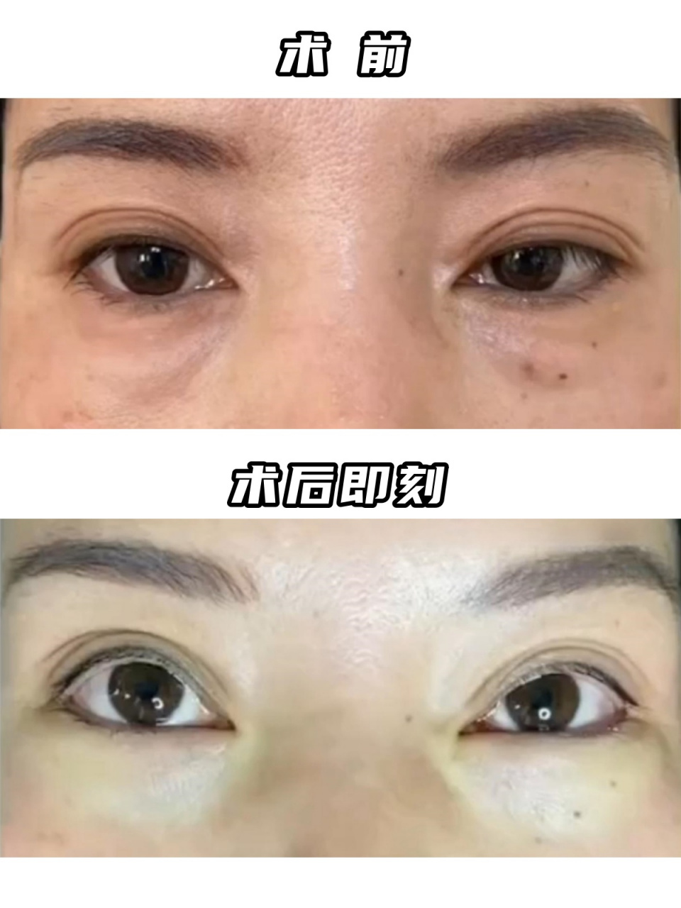 内切眼袋 填充泪沟 术前:双侧眼袋,伴泪沟 67术后:双侧下睑平整