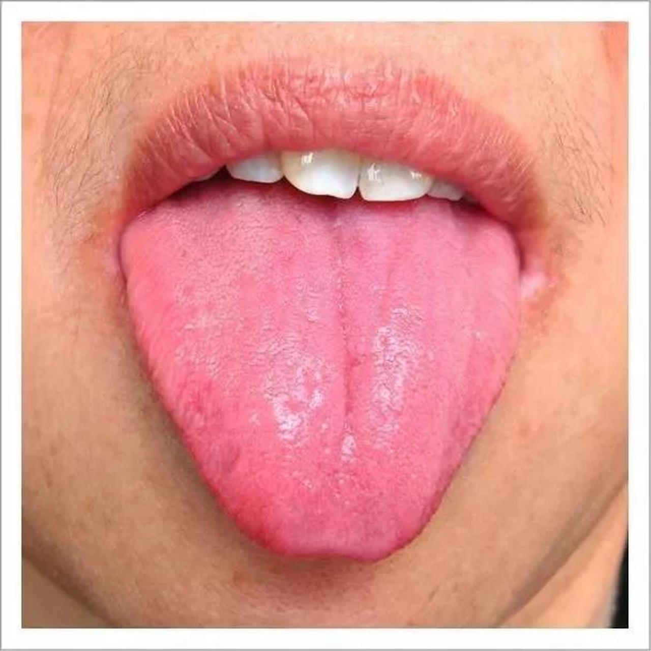 这是正常的舌苔类型,如果疾病较浅较轻,没有影响到脾胃的正常功能
