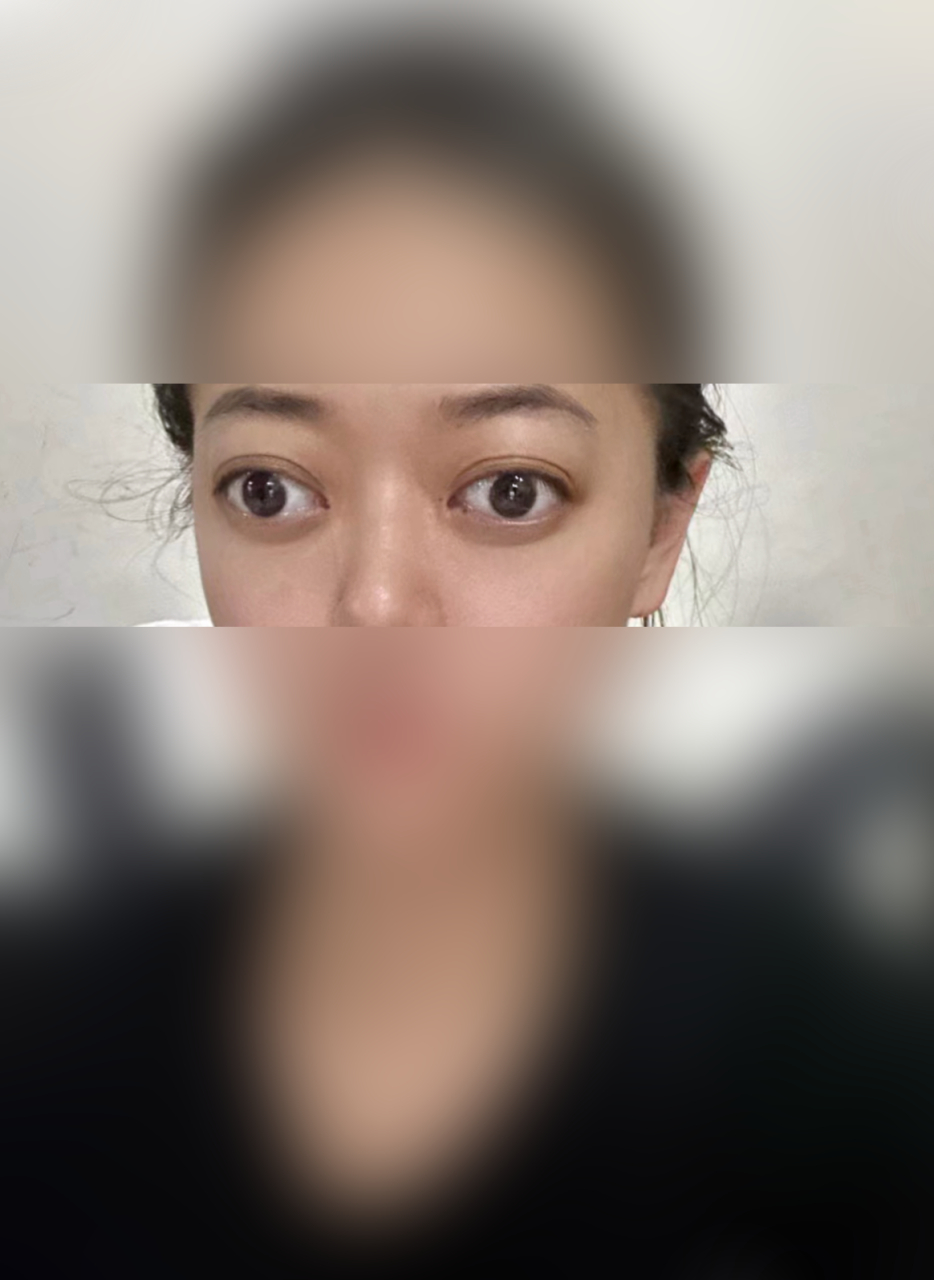 这位患者是一位35岁的女性,她的甲亢持续了半年时间.