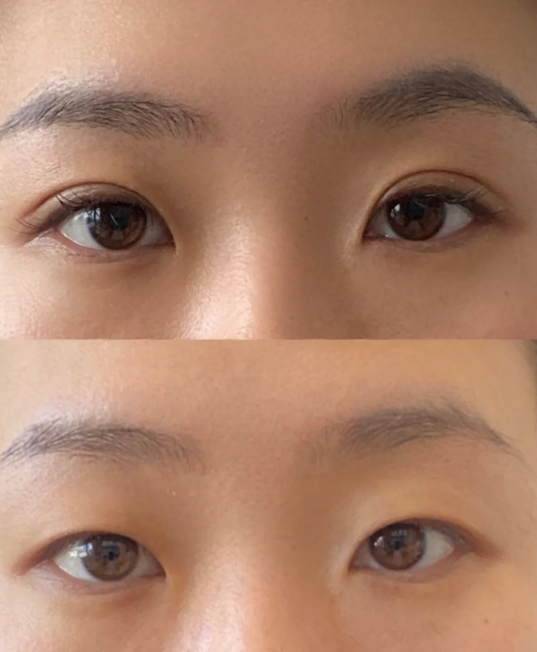 【真实案例分享】 埋线双眼皮一个月啦 已经很自然啦知足了 #埋线双