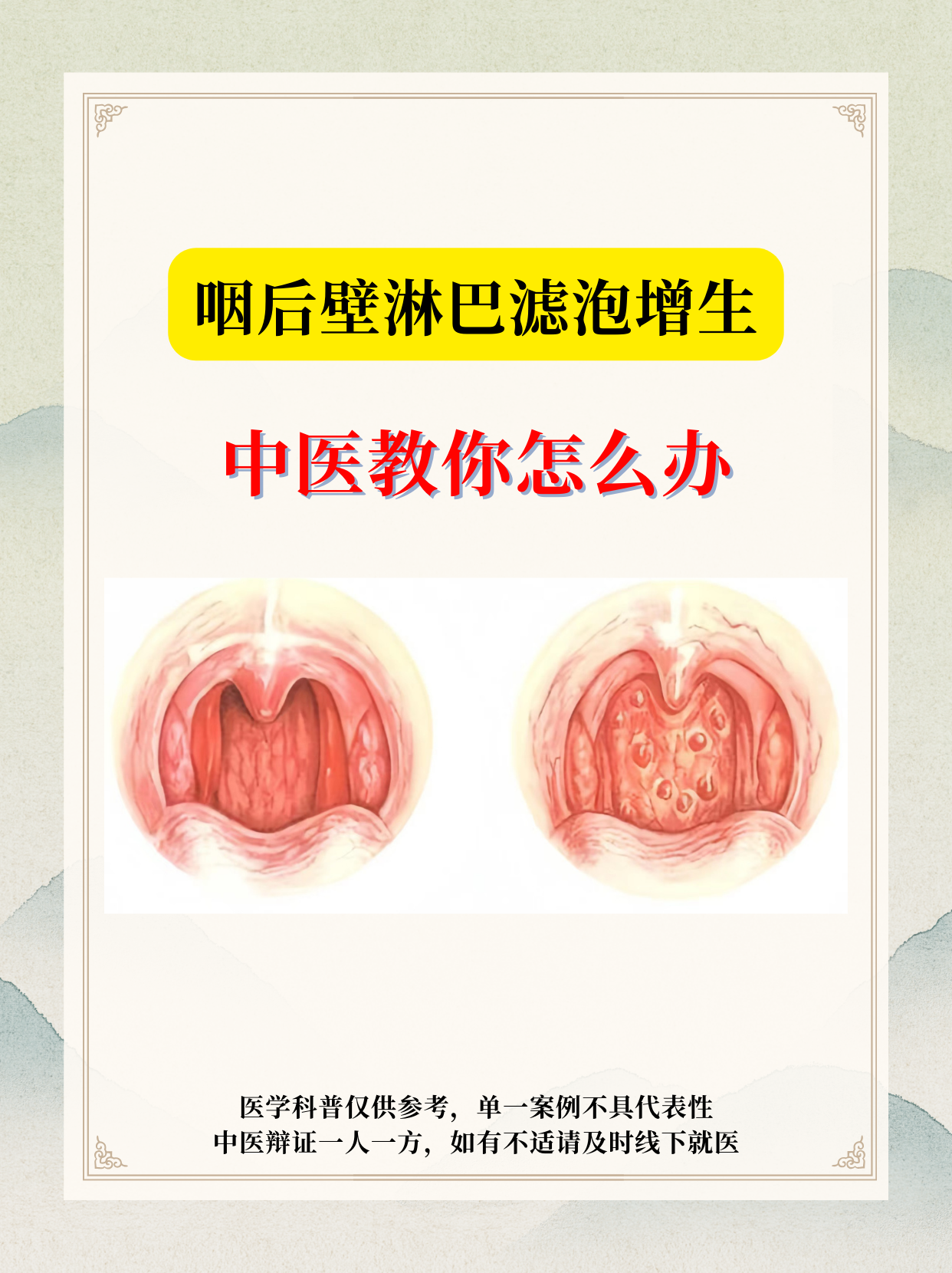 咽后壁淋巴滤泡增生,不要慌!中医教你怎么办