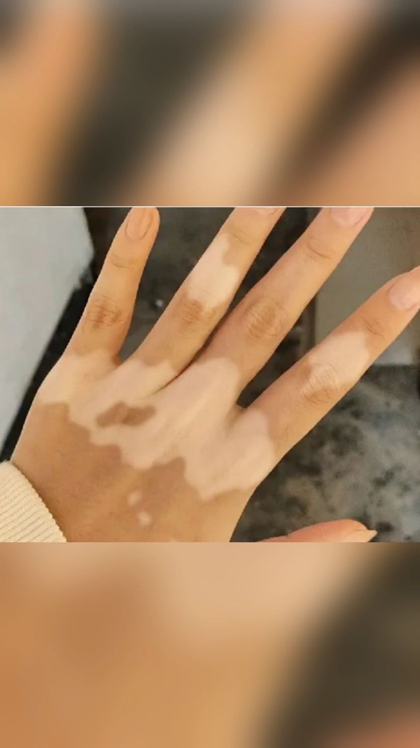 可怜的手,被白癜风变成小花手了