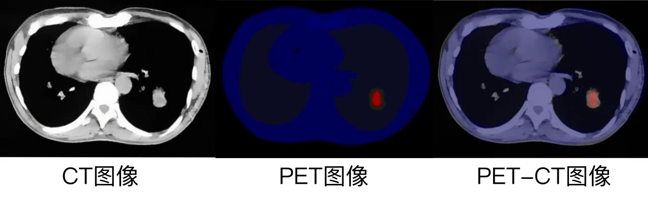 pet-ct和增强ct是一回事吗？