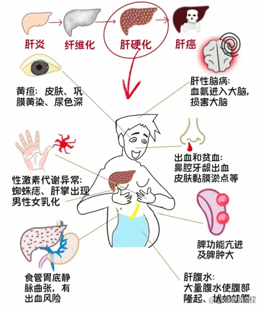 肝硬化发病机制图图片