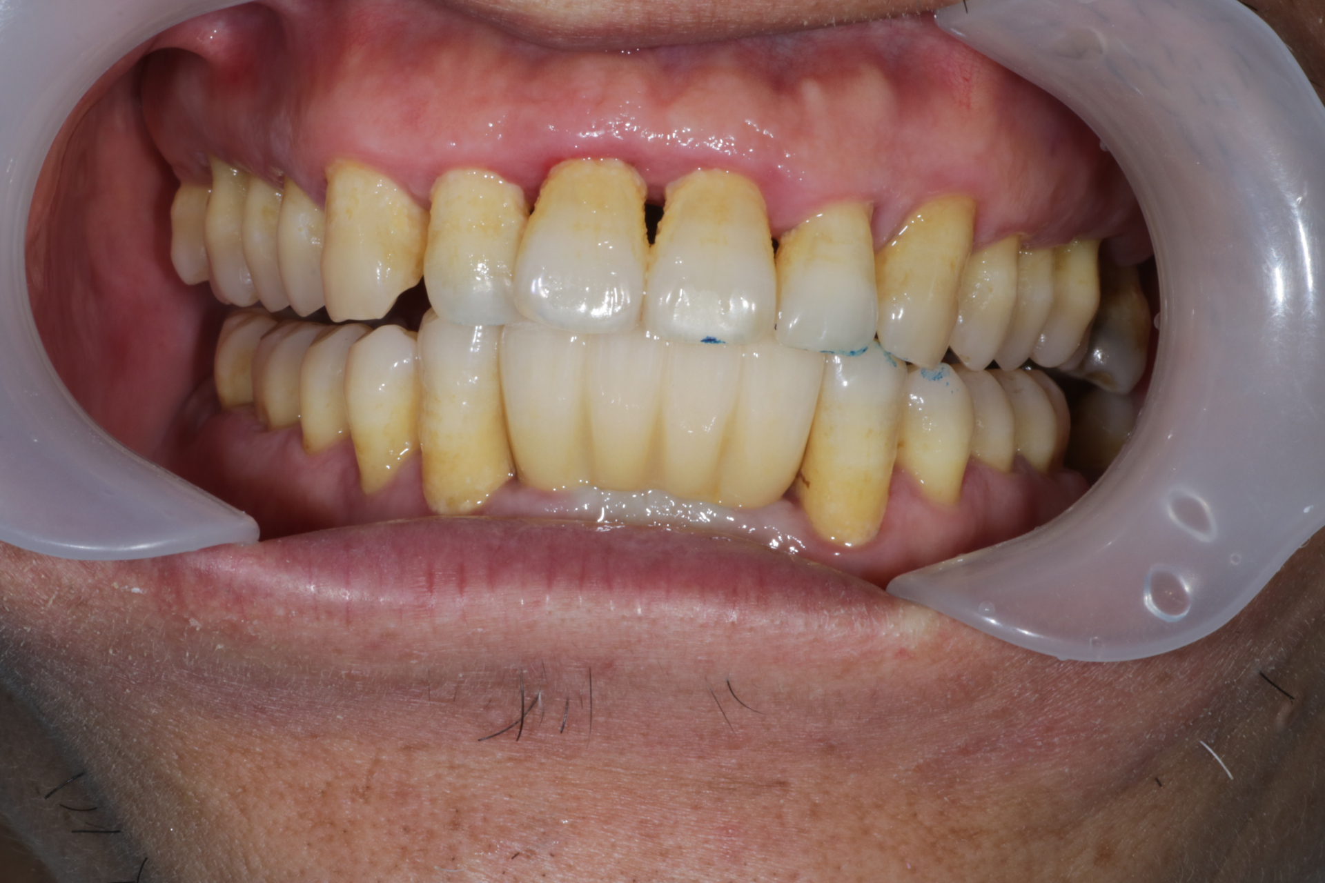 患者是一位五十多岁的大叔,下前牙松动求诊.