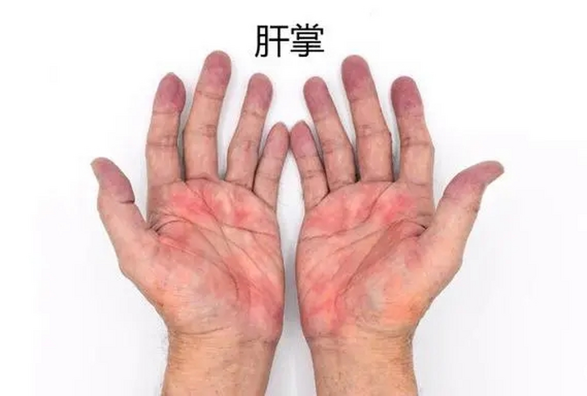 今天早上查房的时候,看到一例典型的肝掌!