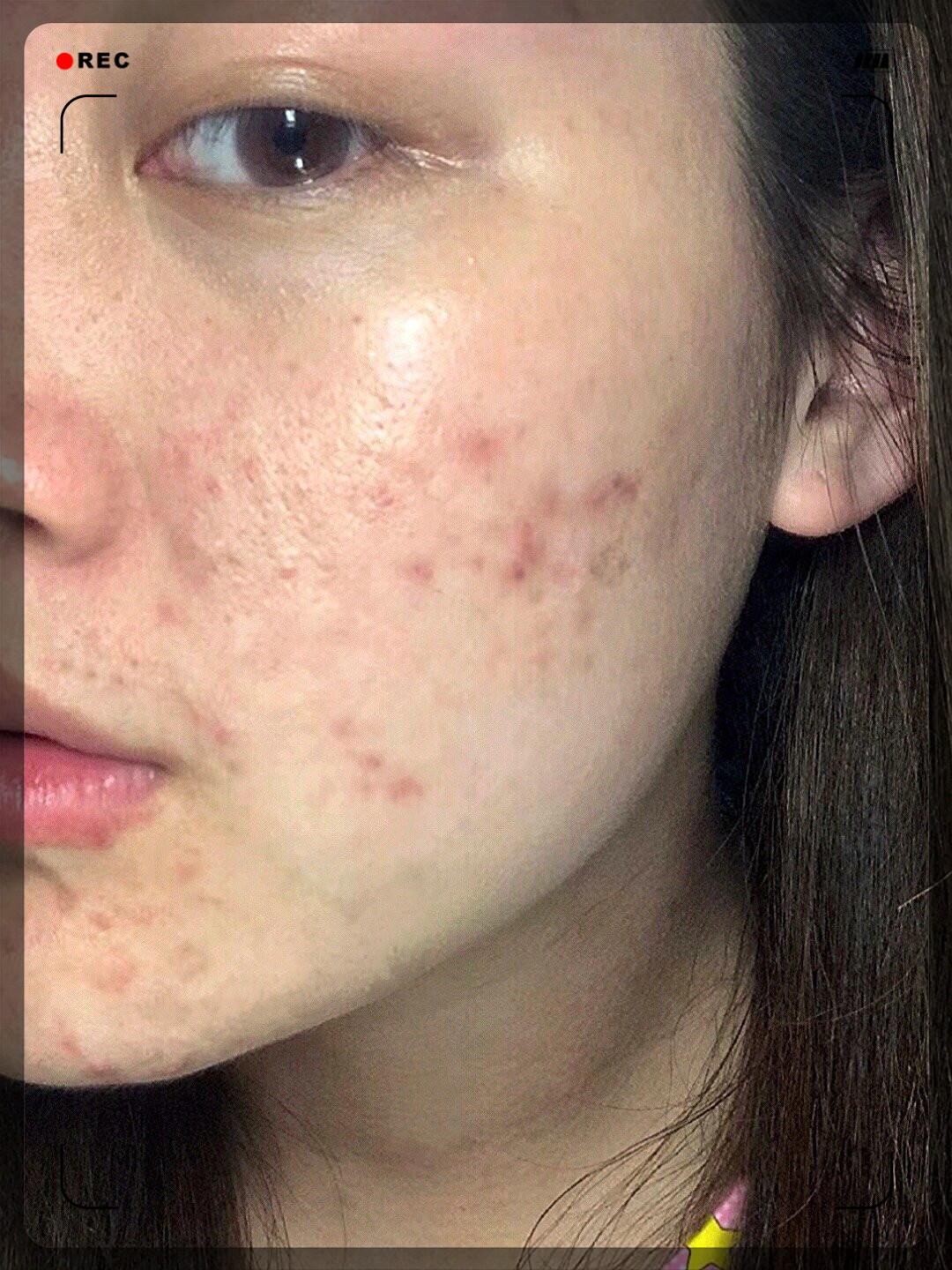 它的温和配方连敏感痘印图片黑痘印痘印黑痘印图片痘印图片女脸上痘印