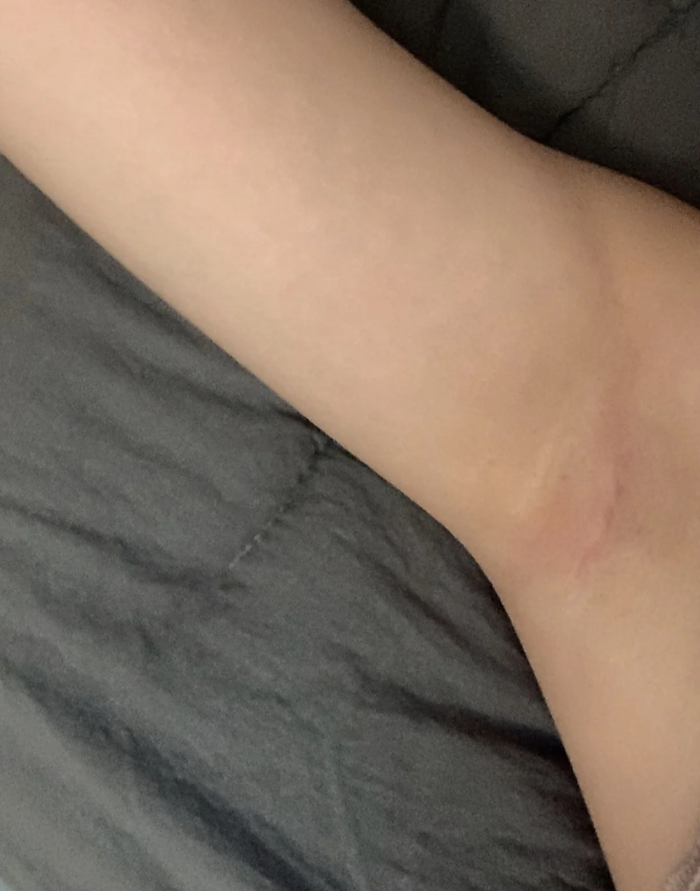 假体隆胸三种切口方式,看看哪种适合你?