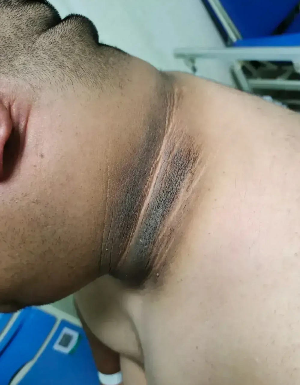 家里的弟弟得了怪病,脖子上有两道黑黑的印子,本来以为是因为弟弟不爱