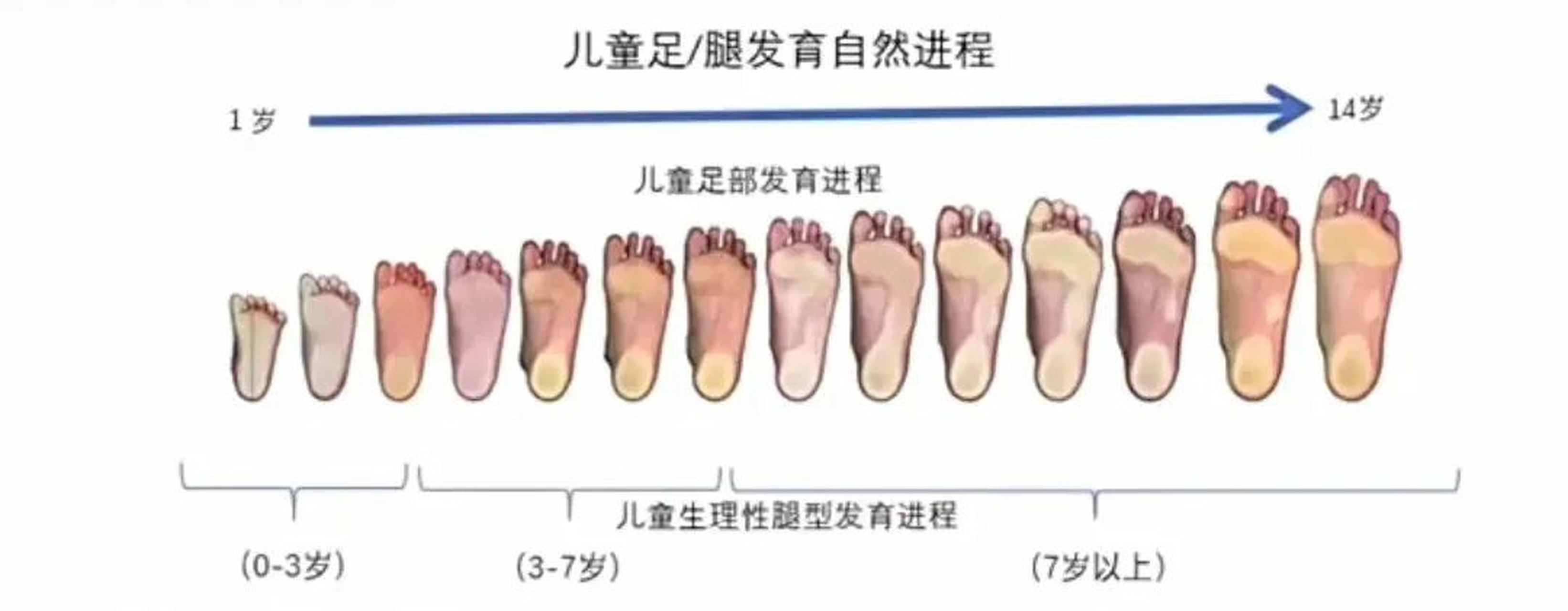 先天足弓塌陷图片