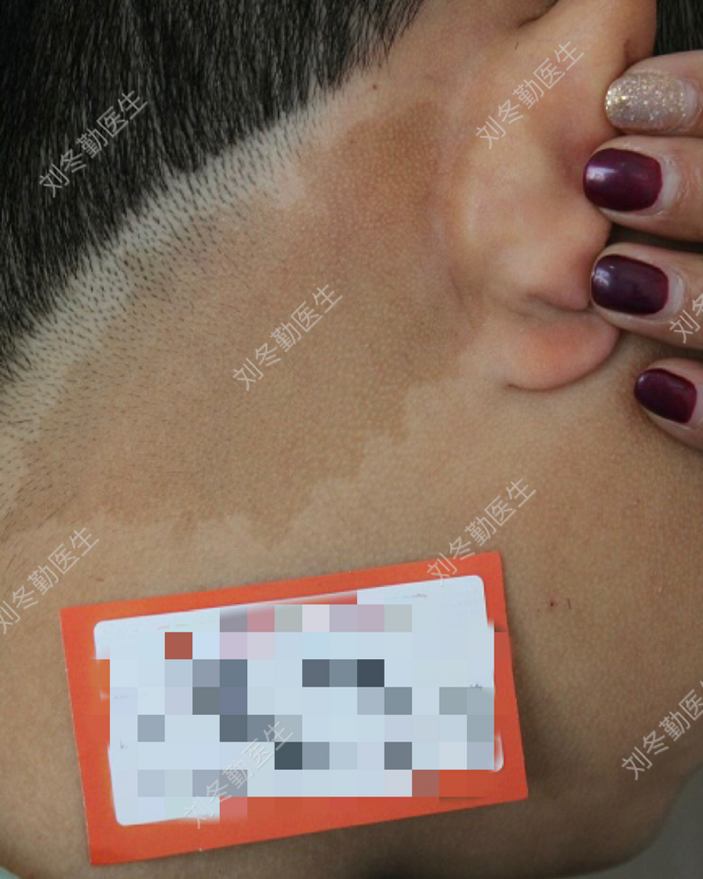 这个小男孩的咖啡斑覆盖了脖子大片,小朋友小朋友们也不知道这是胎记