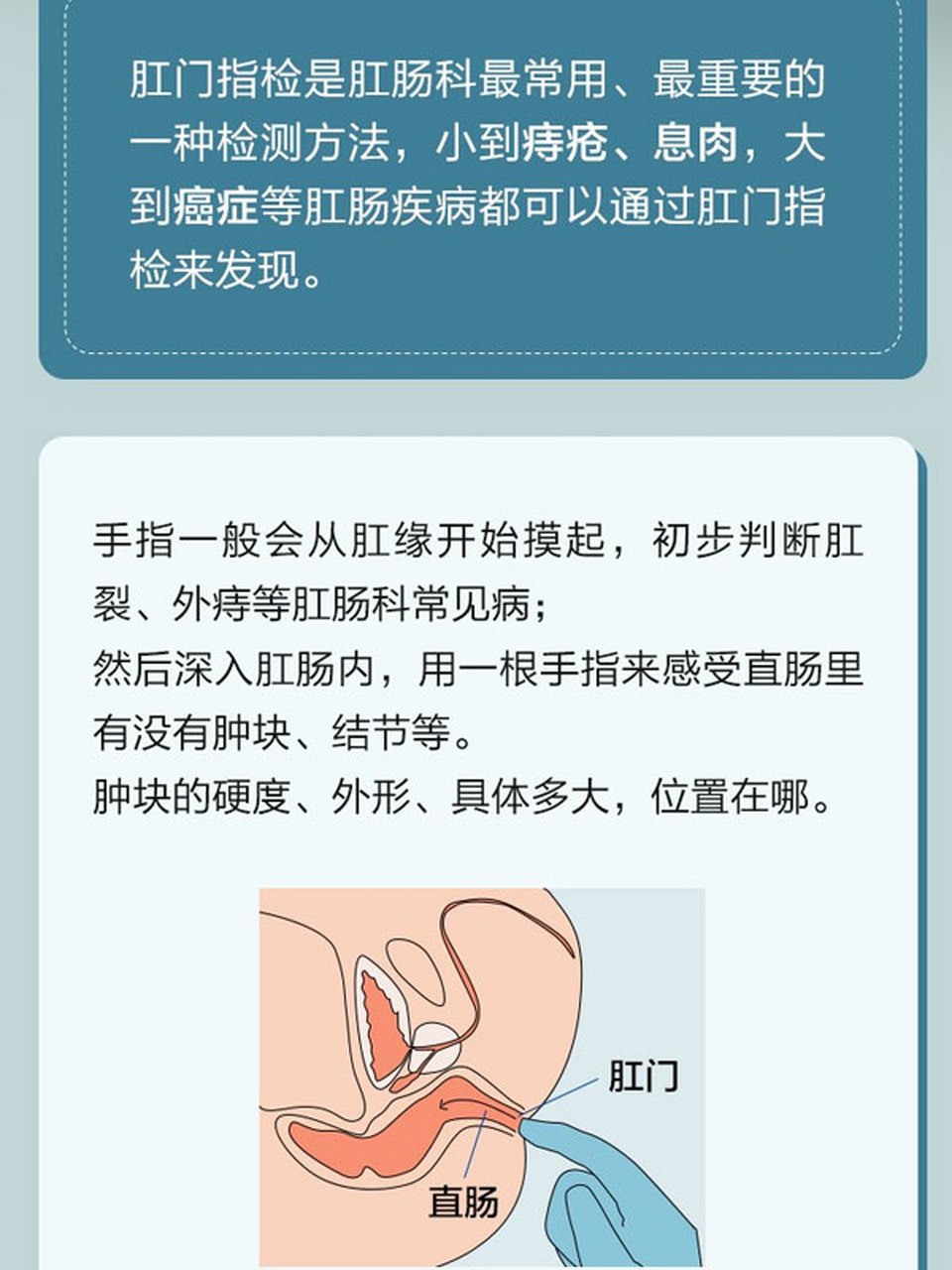 小孩肛门指检图片