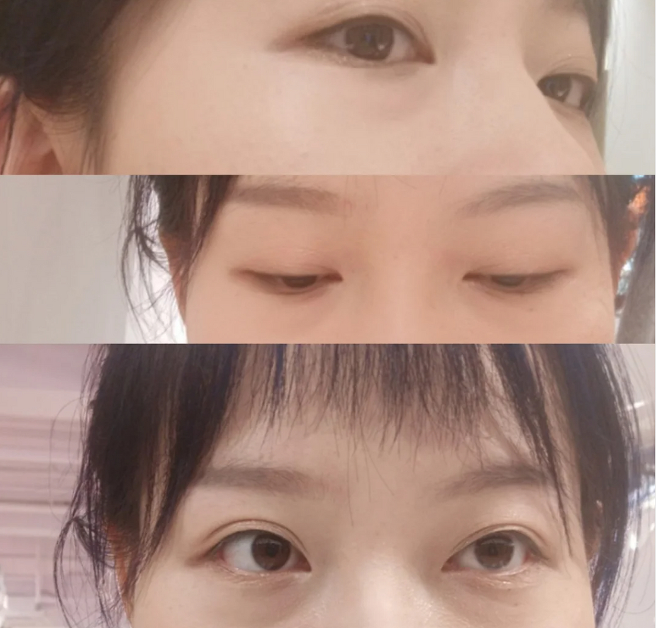 【真实案例分享】内切眼袋 眶隔释放3个月后状况 简单的说一下吧 每个