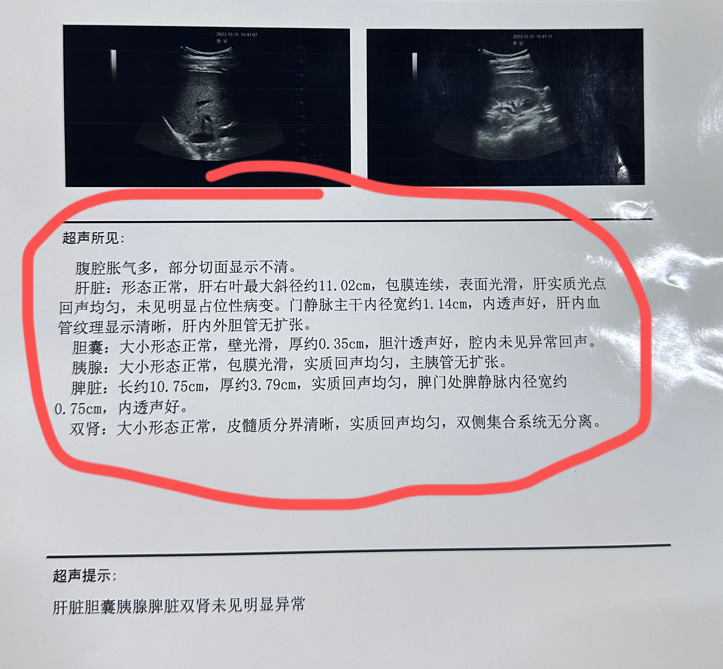 肝脏彩超这7点提示,说明你的肝脏很健康.  第一,肝脏大小,形态正常.