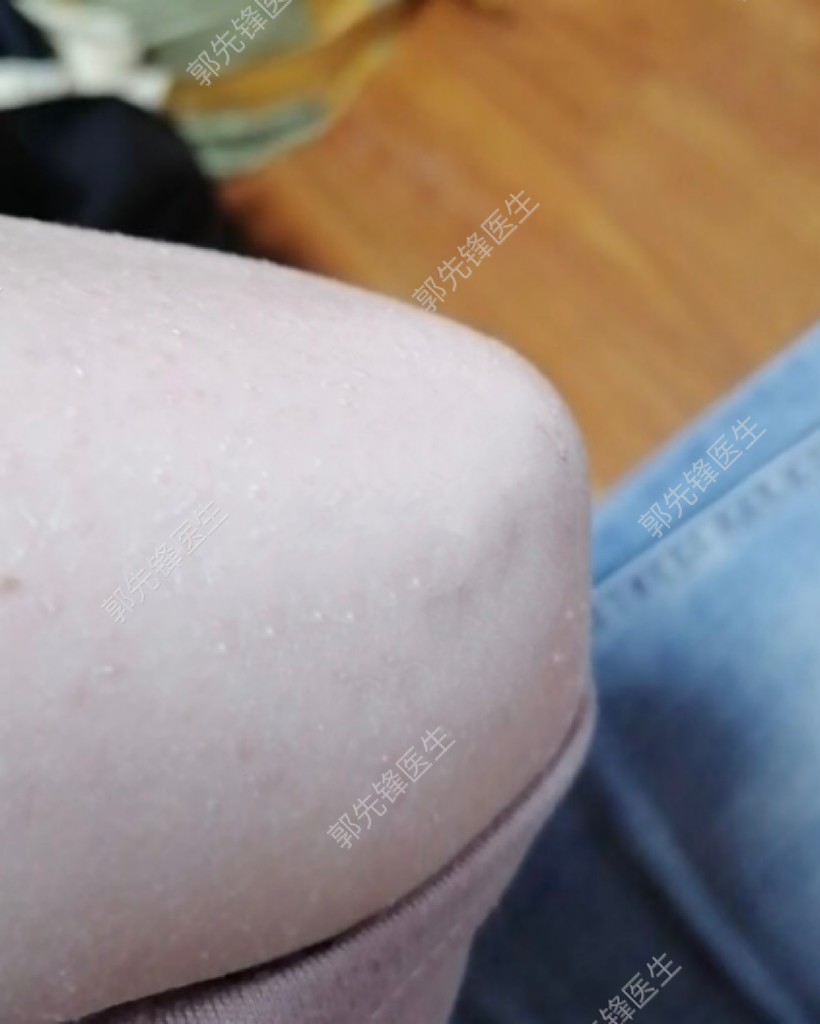 小伙身怀大"痣",却被现实击垮  这个小伙出生时腿上就长有一块黑痣