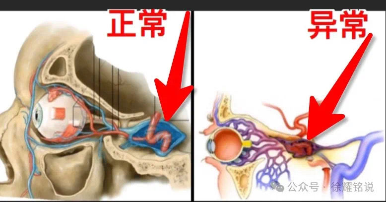 海绵窦血栓图片