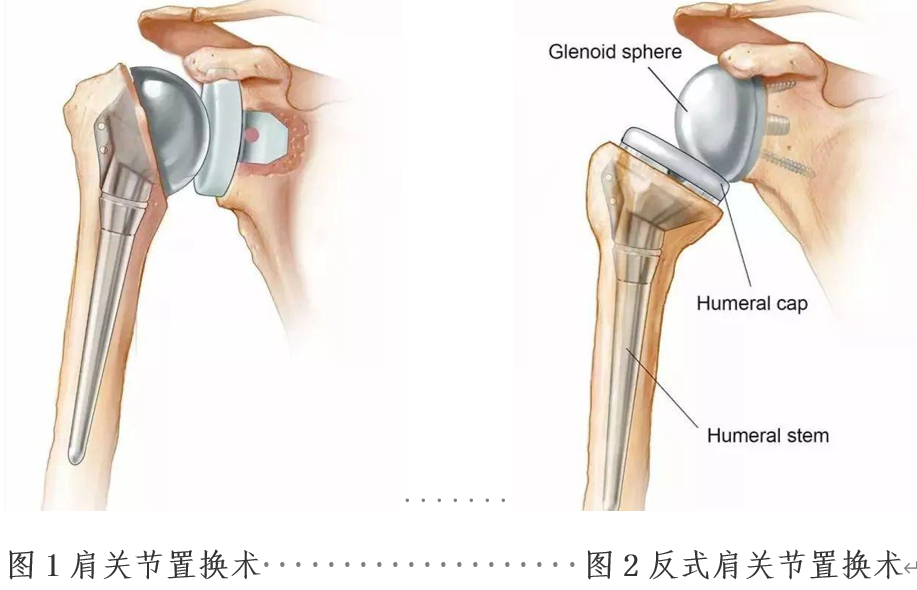 glenoid图片