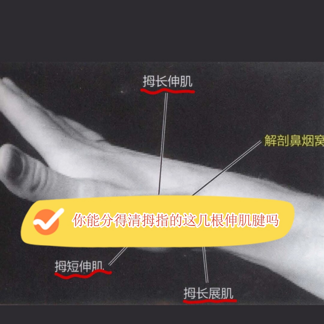 你能分得清拇指的这几根伸肌腱吗