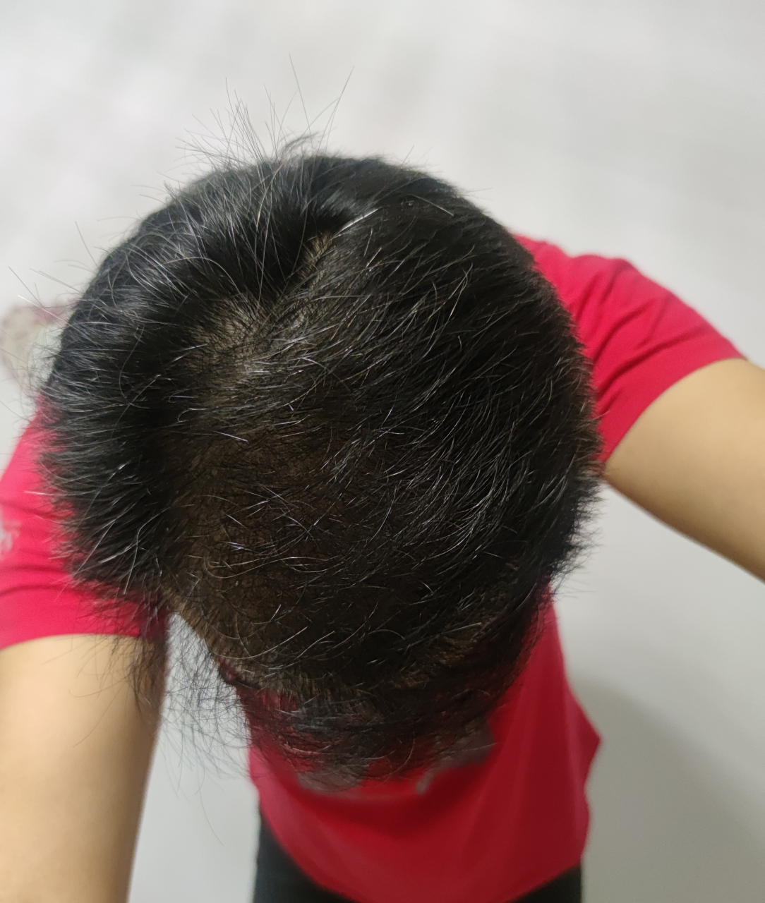 植发十一个月零七天头顶恢复情况,不是太浓密,还有不少白头发,妈妈呀.