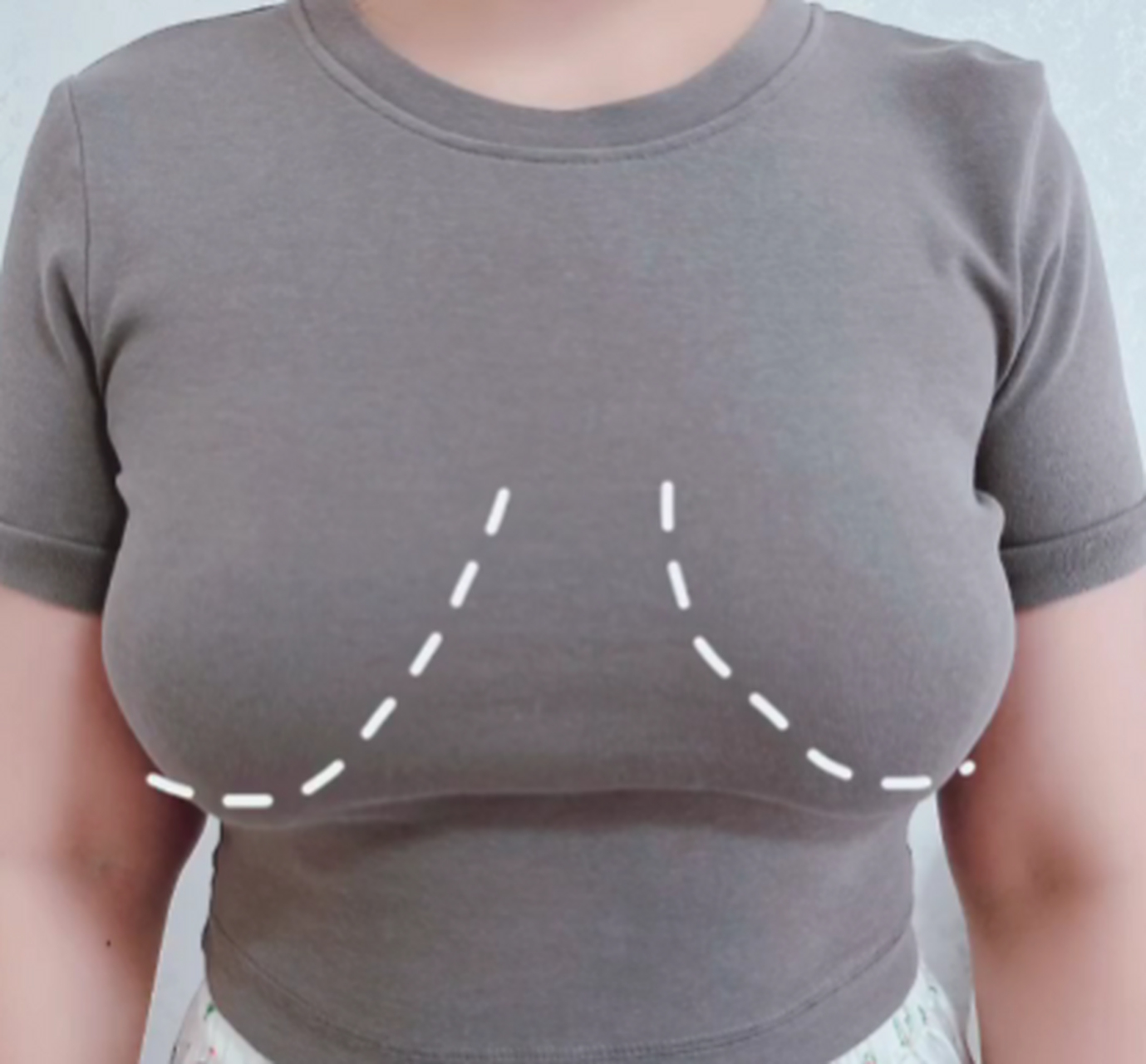 各位大胸,下垂的姐妹们,我想说,胸部提升真的是一场身体和心灵的解放!