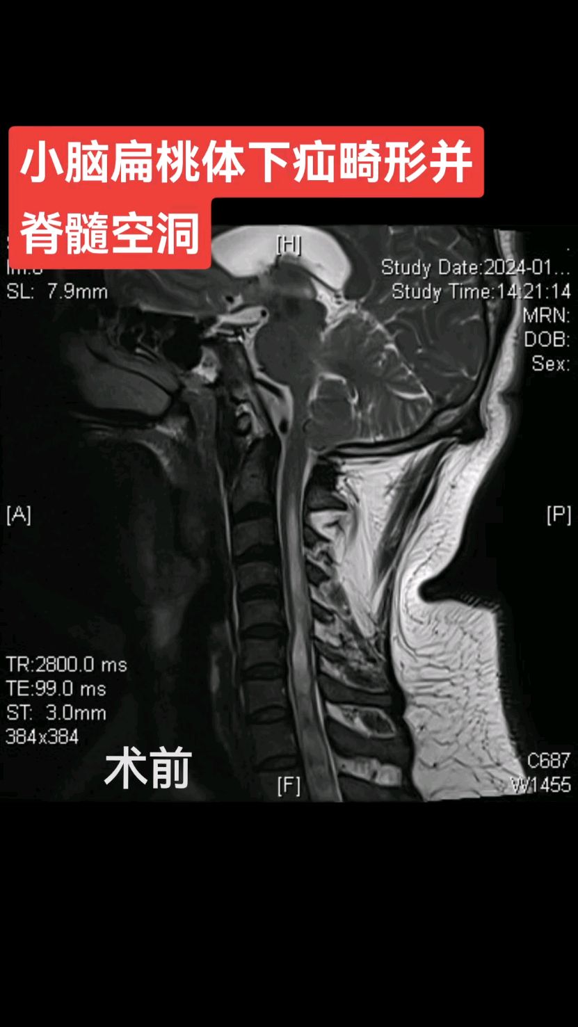 小脑扁桃体下疝ct图片图片