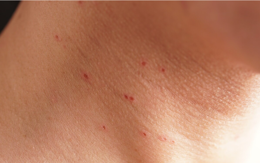 20年退伍军人得血癌,母亲拒绝做骨髓配型,父亲卖5000斤干枣救他