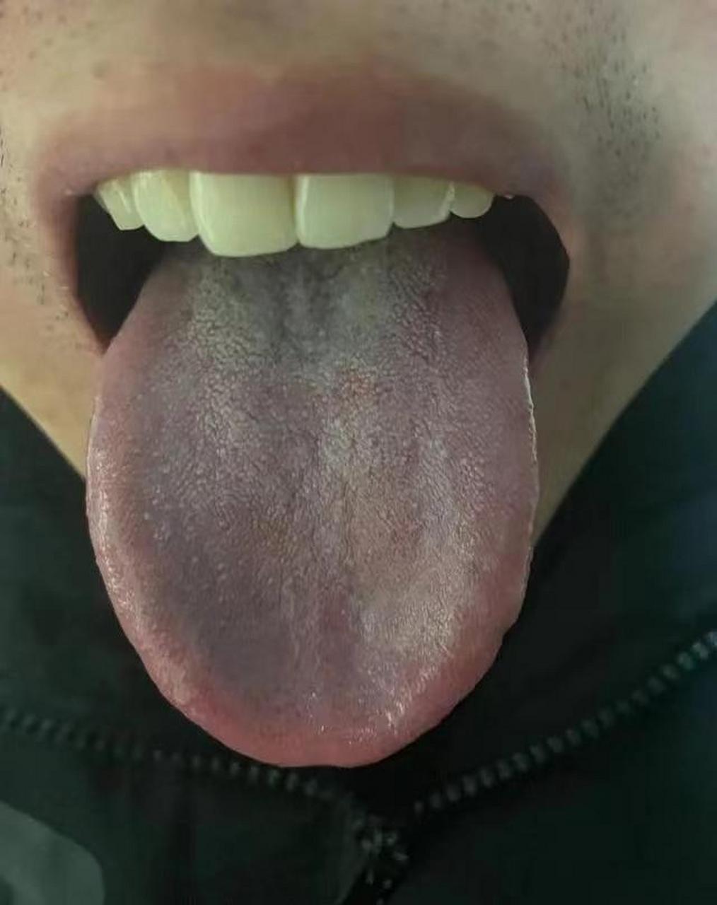 脾虚湿气重,这种舌苔,吃再多的参苓白术,二陈丸,归脾丸都没用 这样的