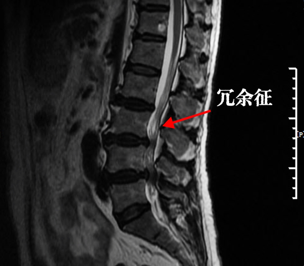 压迫马尾的核磁图片图片