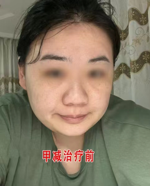 性甲减面容特征图片甲减面容图片甲减婴儿面容特征图片甲减患者得了