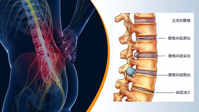 小针刀治疗腰椎间盘突出的原理.@针灸科刘乃刚的动态