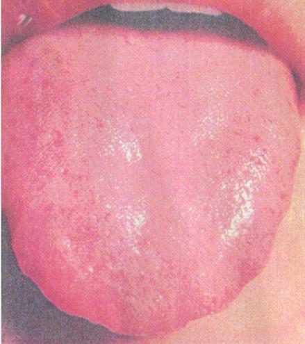 一,正常舌象 正常舌象:舌体柔软,活动灵活,颜色淡红,舌苔薄白,干湿