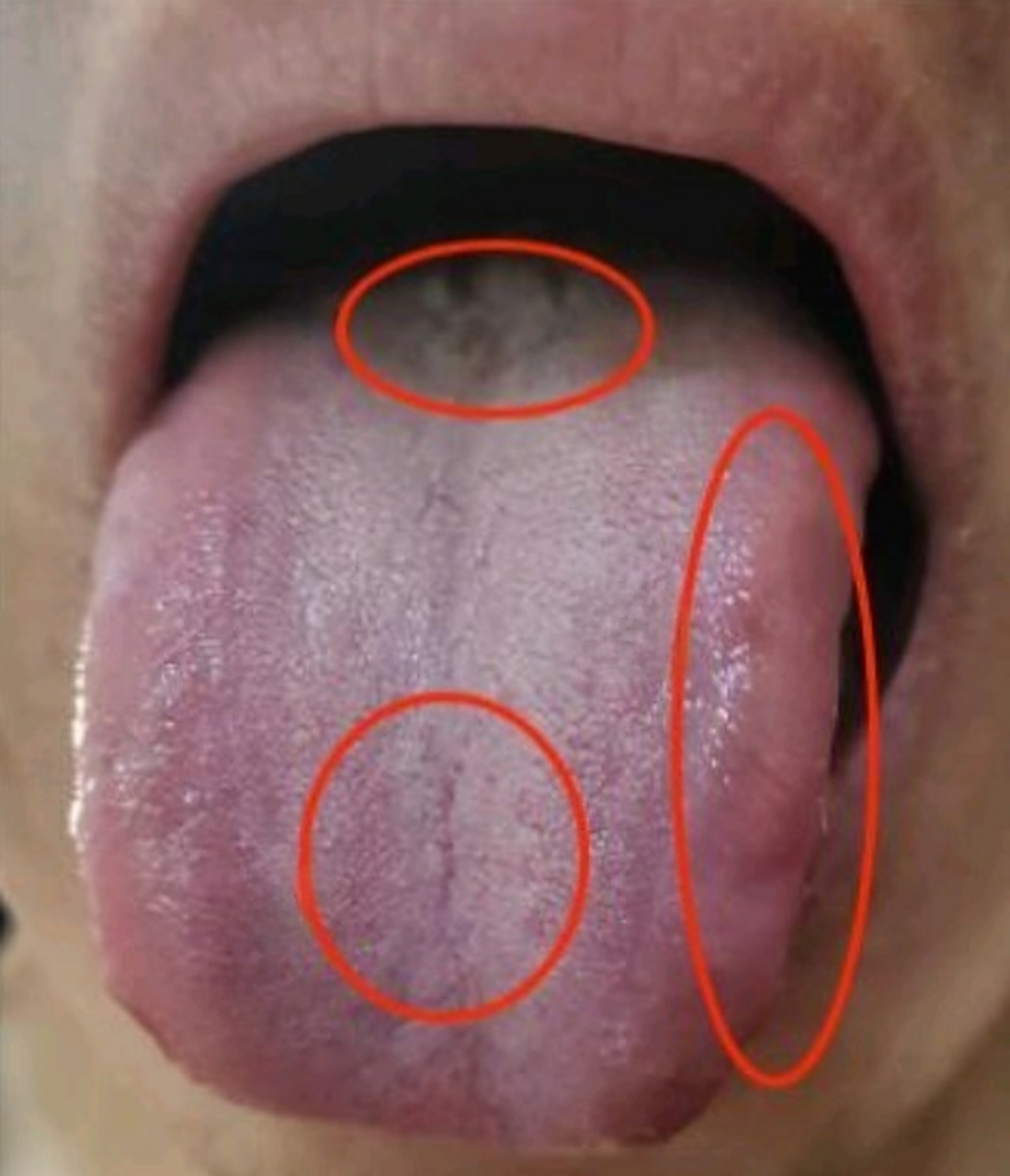 男科不行,时间不理想,还有前列腺炎,这种舌头真难调!