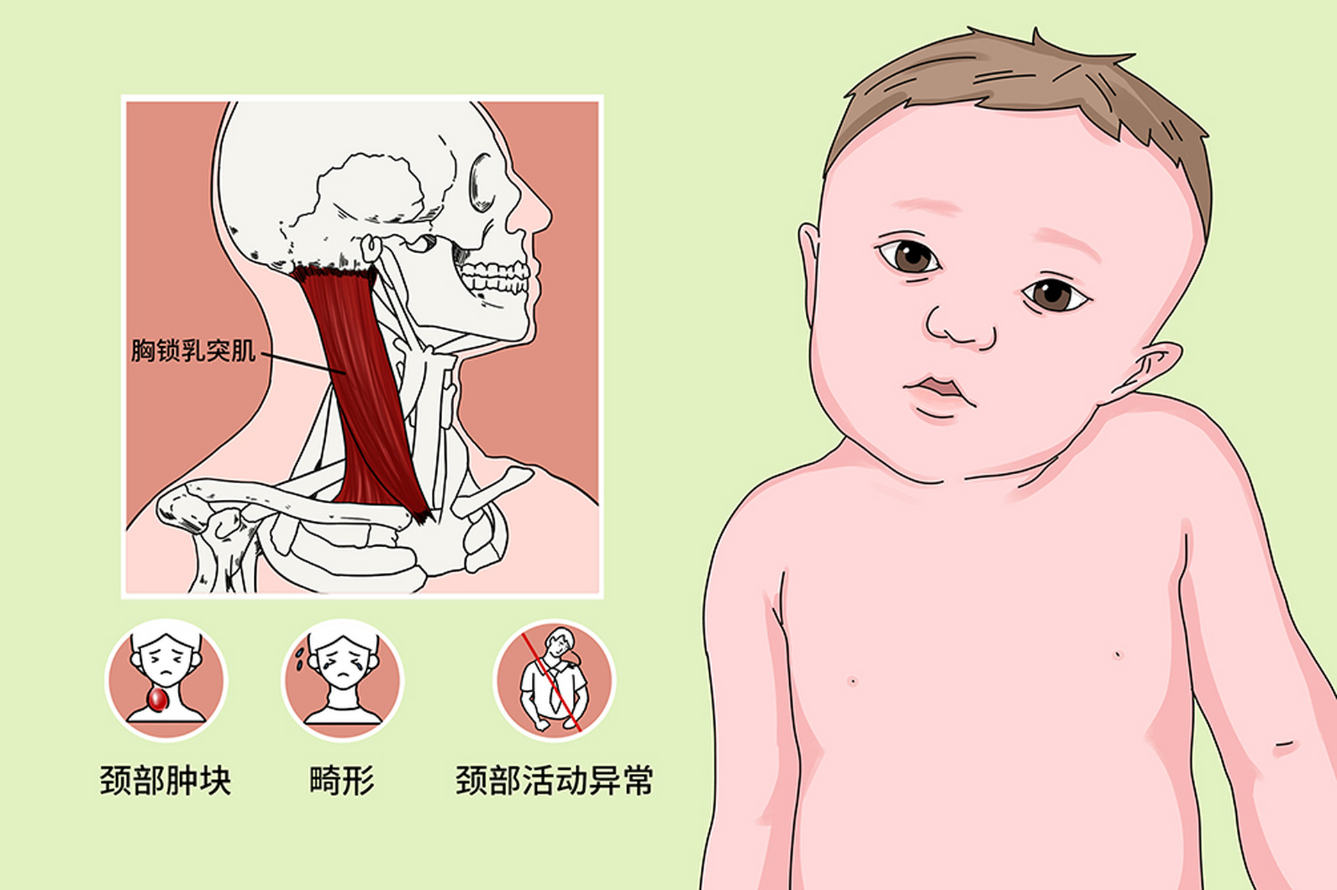 先天性斜颈图片的表现图片