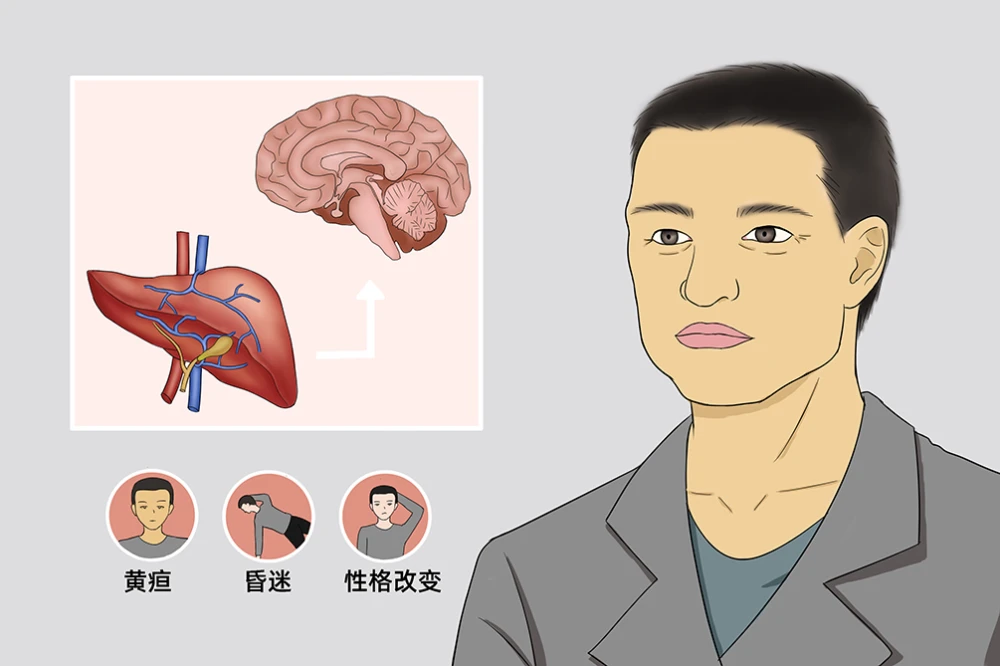 肝硬化患者性情大变,罪魁祸首居然是俩鸡蛋"?