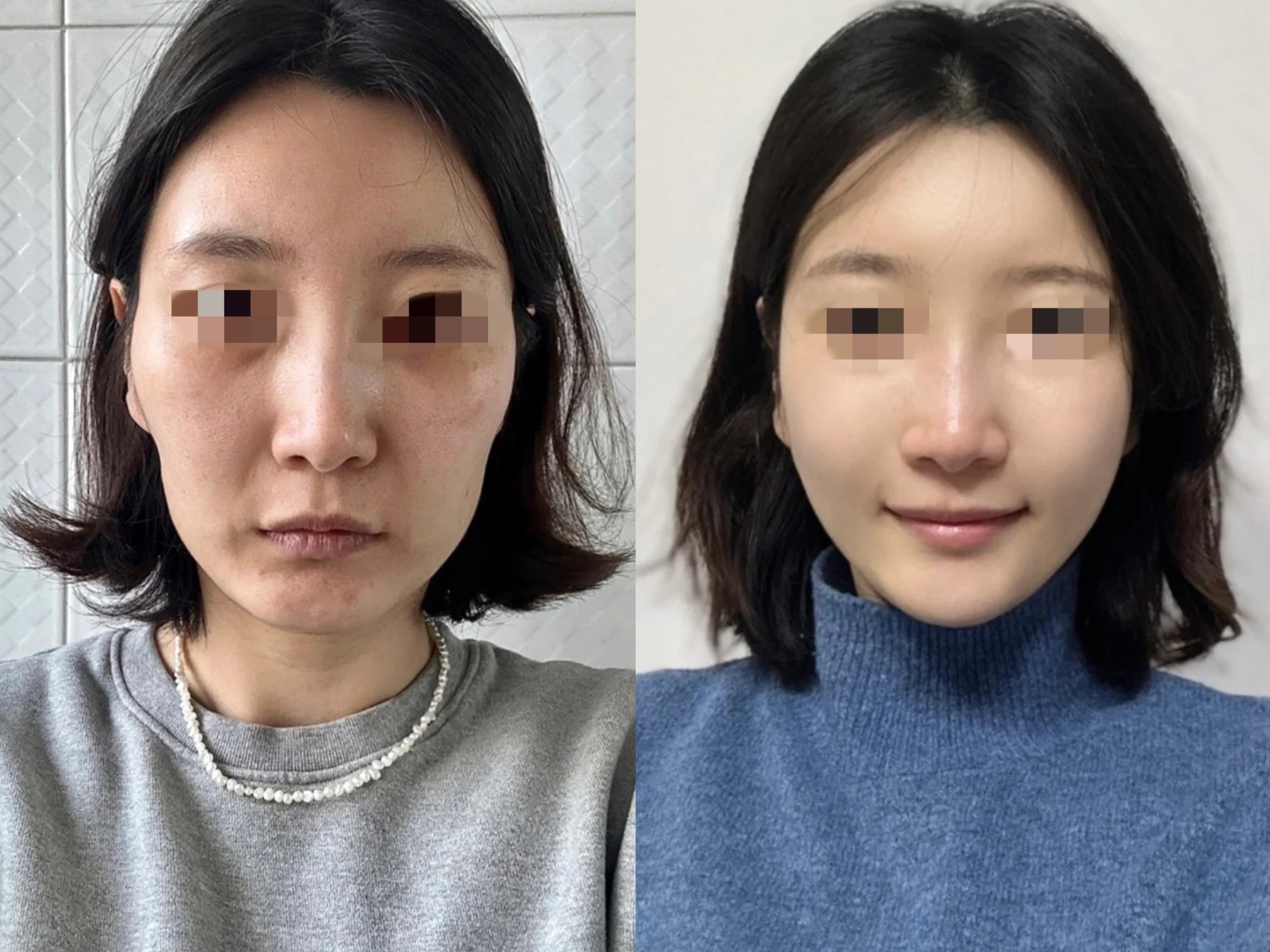 43不开刀做了个无痕筋膜悬吊后,衰老的痕迹消失了!
