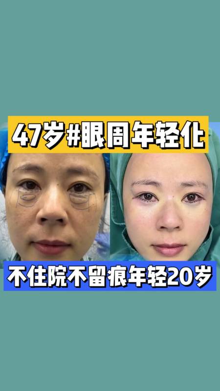 47岁眼袋泪沟黑眼圈严重做完眼周年轻化即刻紧致平整年轻20岁连法令纹