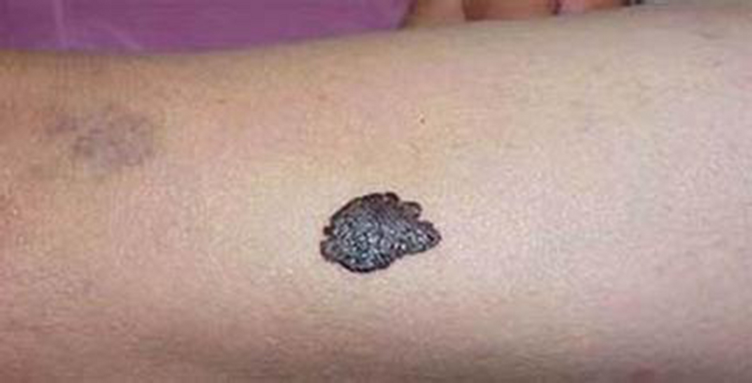 "我发现男朋友那里长了一颗痣,大约有7mm,听说黑色肉痣会变成黑色素瘤